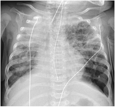 Imaging Bronchopulmonary Dysplasia—A Multimodality Update